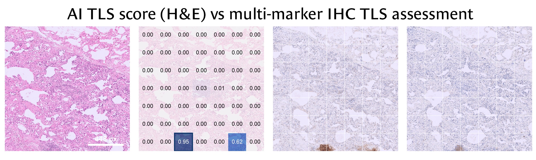 Dense lung tissue: almost every AI tile score is 0.00; one tile at the lower edge scores 0.95 where the IHC shows a small stained focus