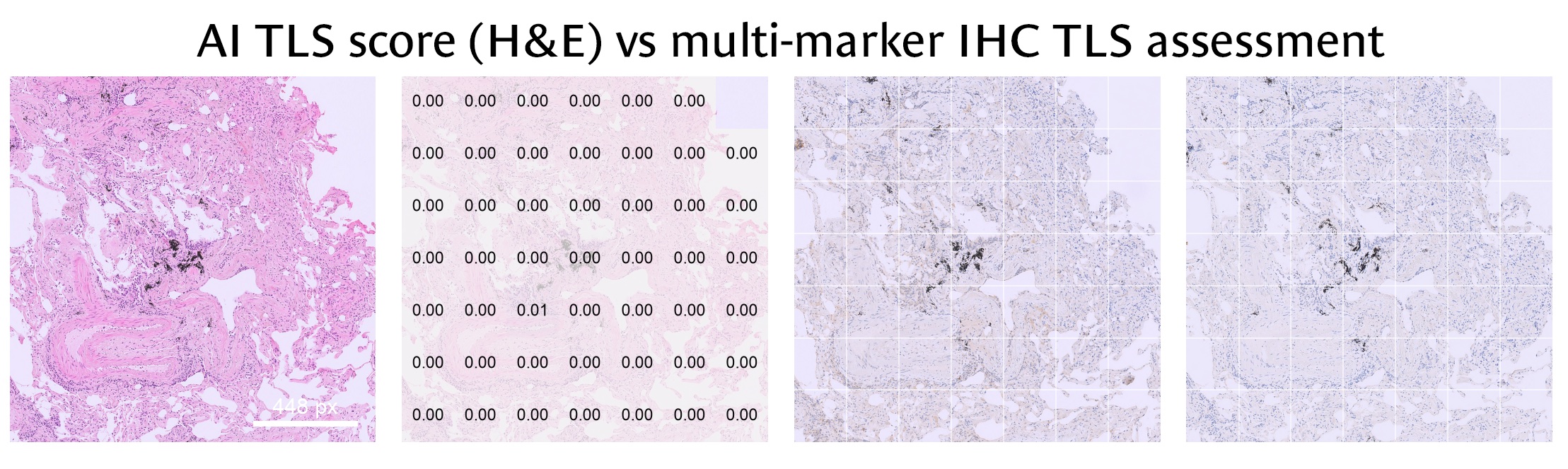 Tissue with a vessel and black pigment: every AI tile score is 0.00 or 0.01 and the IHC shows no TLS staining