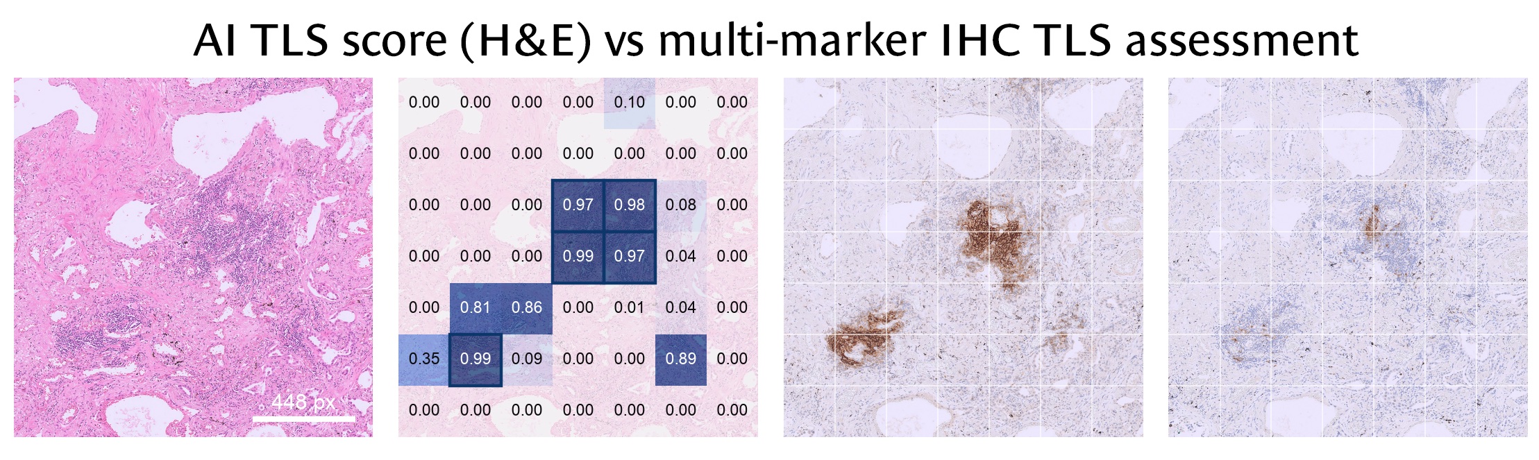 Region with two TLS: H&E, AI tile scores up to 0.99, and two IHC markers staining the same two areas