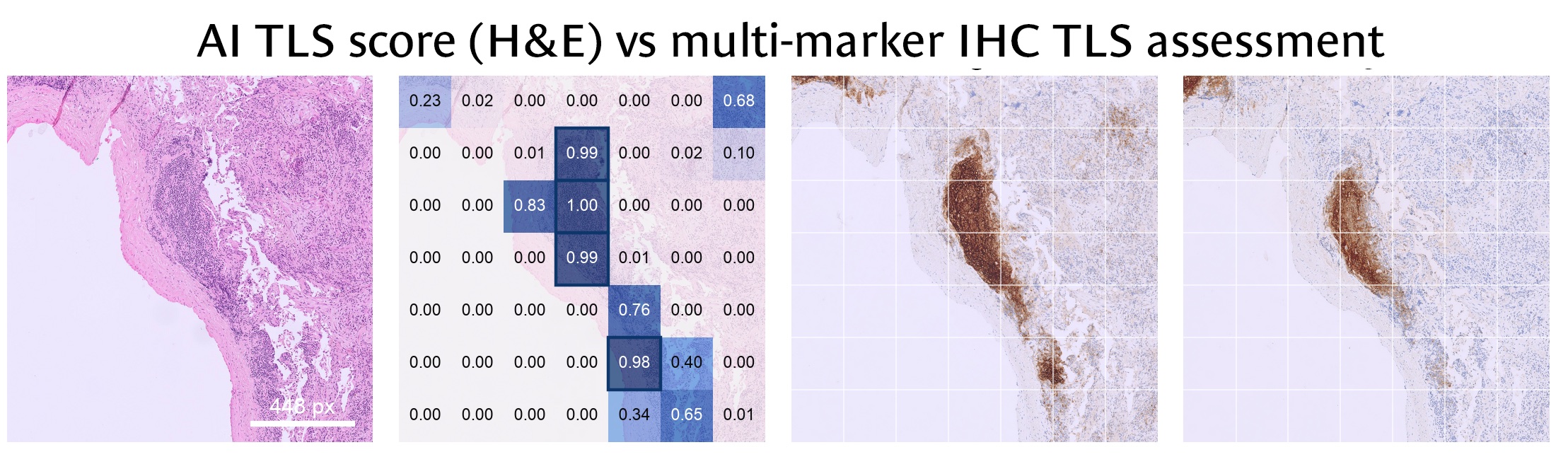 Elongated TLS: H&E, a diagonal band of AI tile scores up to 1.00, and two IHC markers staining the same band