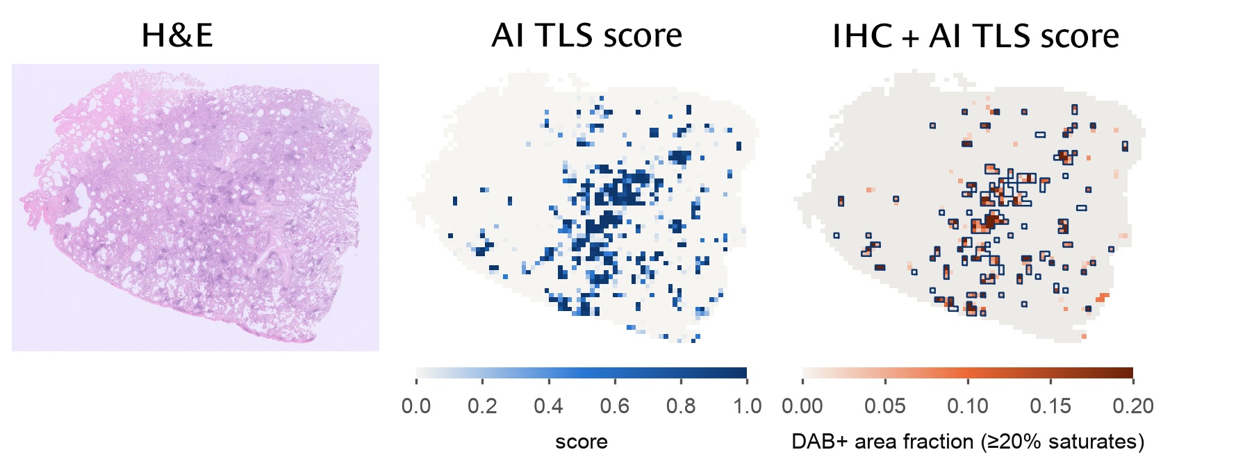 Whole lung slide: H&E, the AI TLS score per tile, and the IHC staining with the AI's TLS tiles outlined; the outlined tiles sit on stained areas