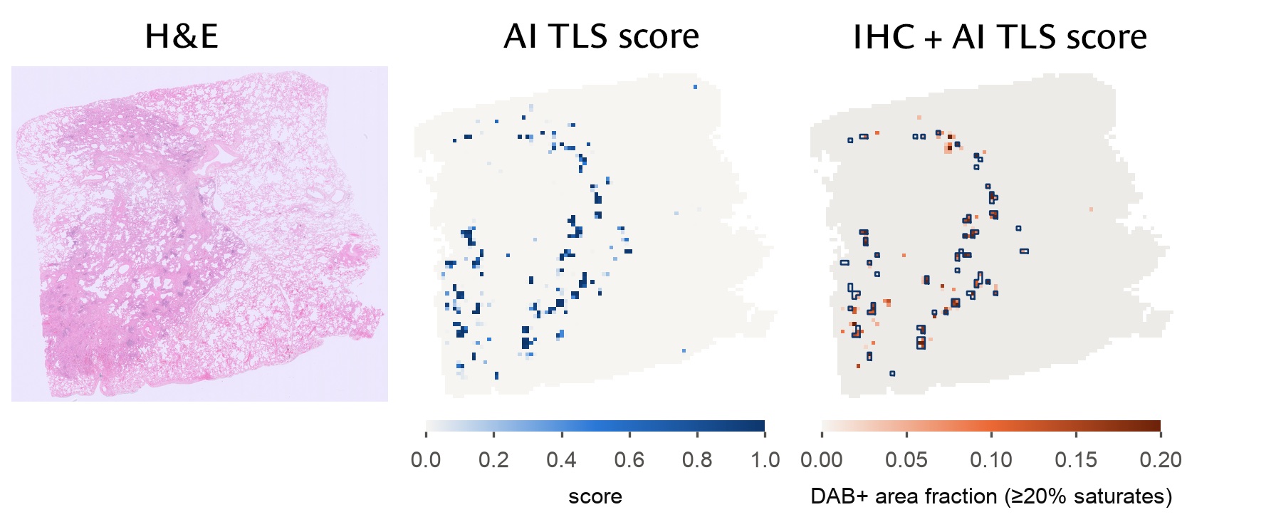 Second whole lung slide: H&E, the AI TLS score per tile, and the IHC staining with the AI's TLS tiles outlined; the outlined tiles follow the stained areas